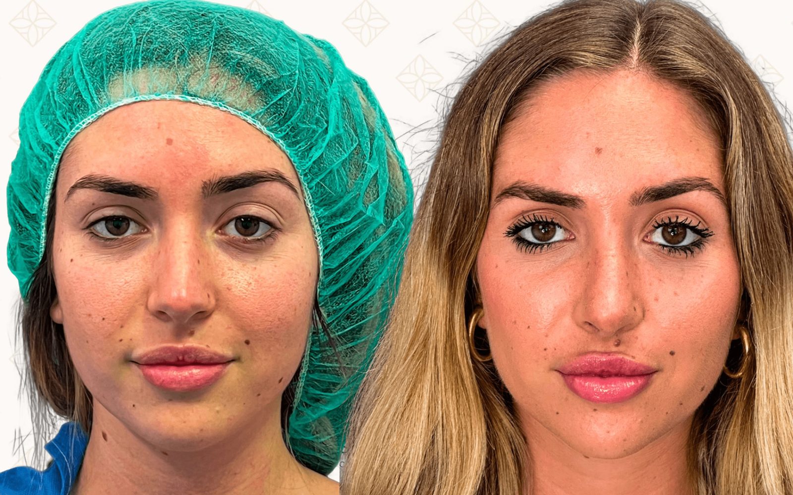 Rinoplastia — antes y después (frontal)