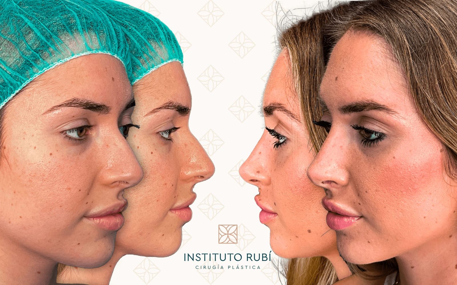 Rinoplastia — antes y después (perfil)
